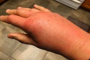 Can Fire Ants Kill You? Just How Dangerous Are They?